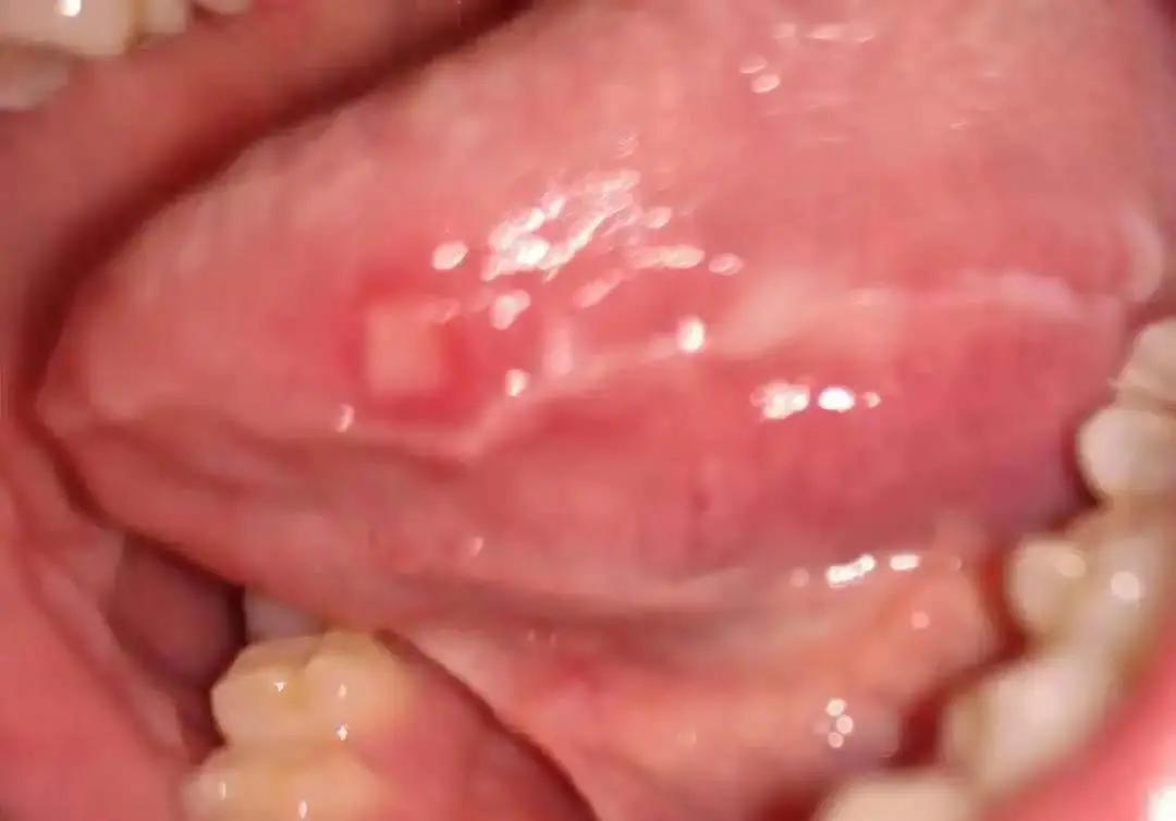 深圳男子口腔溃疡8年，还蔓延全身！竟是这种怪病！