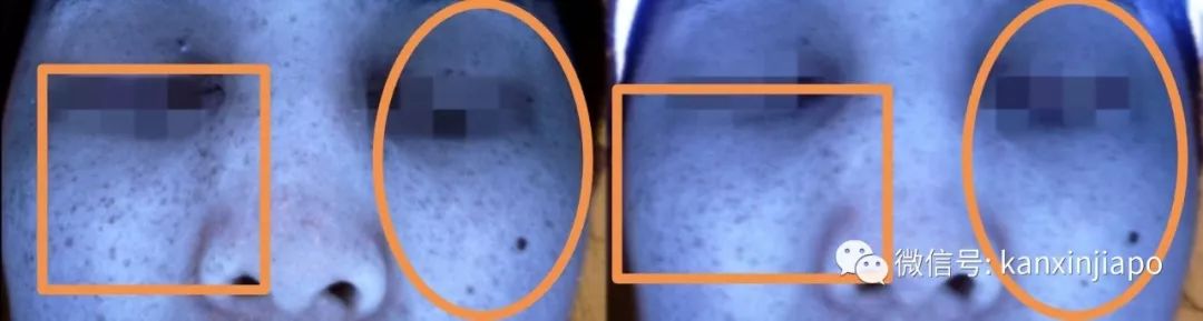 额头长闭口毛孔粗大爆痘怎么办,皮肤爆痘起闭口怎么回事