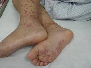 有过敏紫癜是不是更容易得血液病,过敏性紫癜是不是血液系统疾病