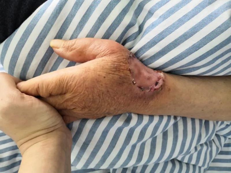 手上长个大犄角，怎么回事？