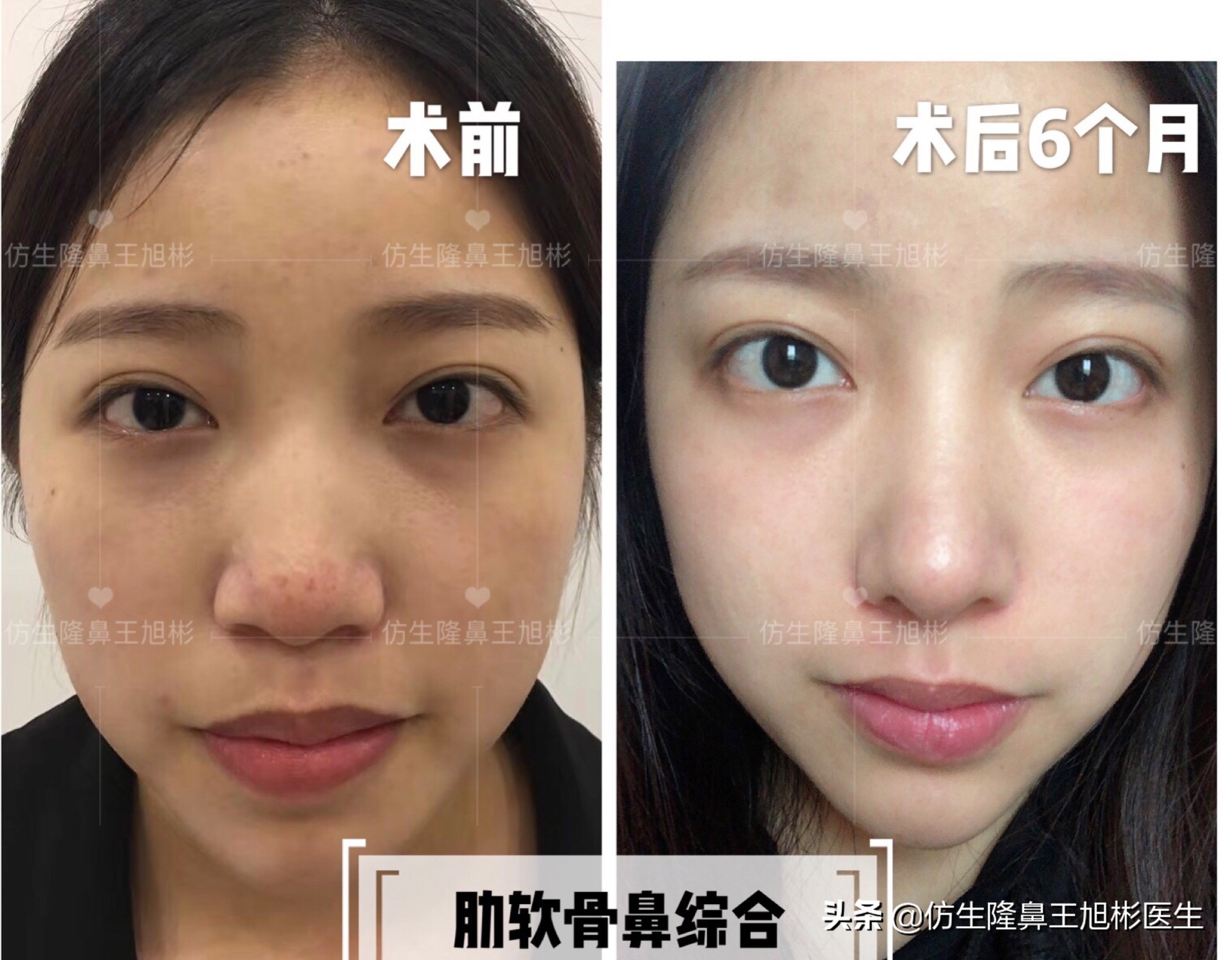 手术鼻头增厚能用什么方法弄,大鼻头高鼻梁缩小手术案例