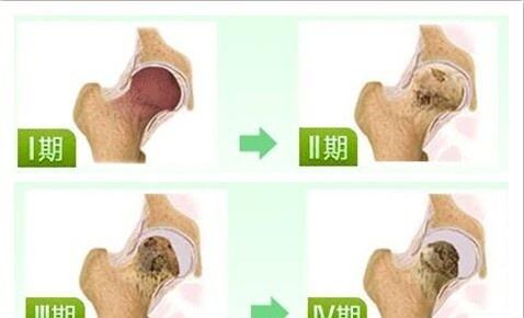 儿童股骨头坏死是怎么引起的,长期吃激素药怎样预防股骨头坏死