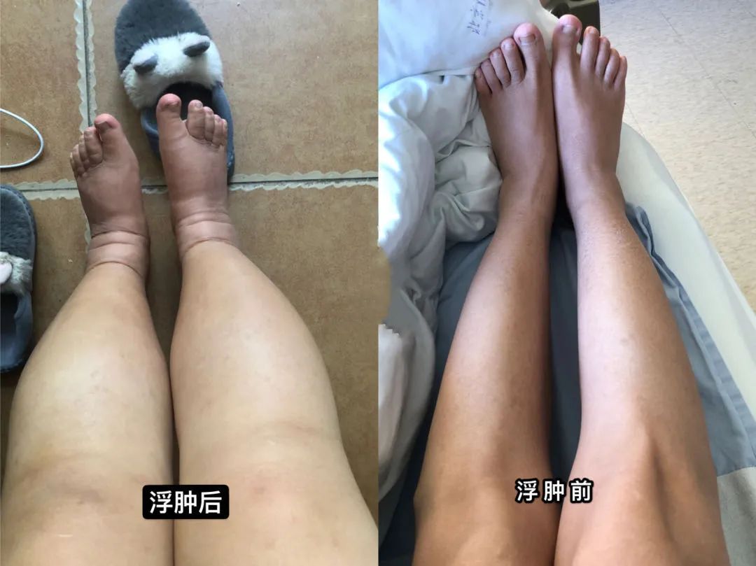 肾炎肌酐200能治愈吗,慢性肾炎肌酐多少需要透析