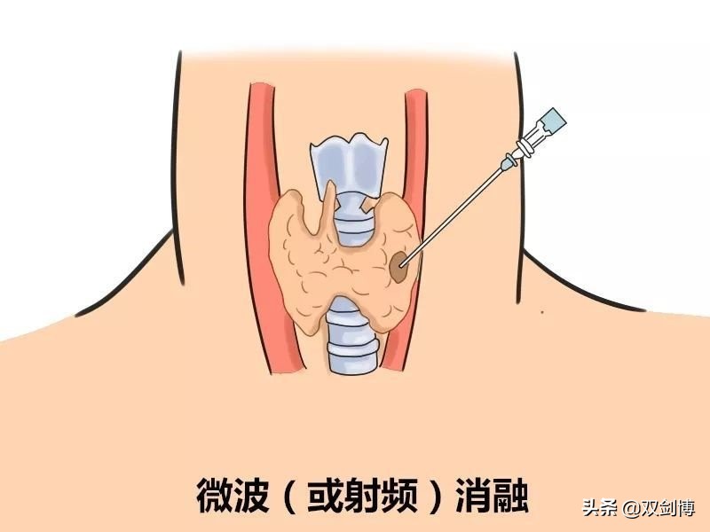 甲状腺癌手术后转移淋巴后果,甲状腺癌术后转移几率大吗