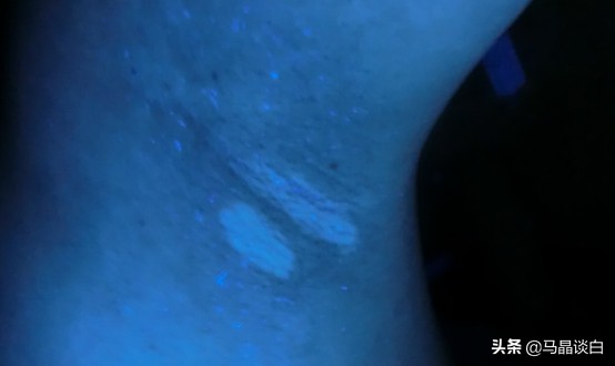 把香水喷在这种地方？19岁女子痛却乐此不疲，白癜风恶化