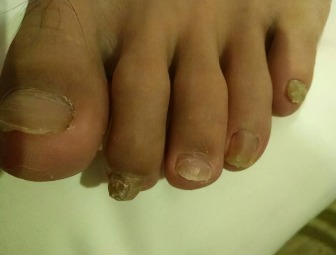 指甲变厚变黄不长了是灰指甲吗,指甲变厚是灰指甲的前兆