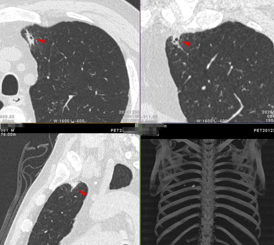 9mm肺结节实性结节良性几率多大,良性肺结节生长速度