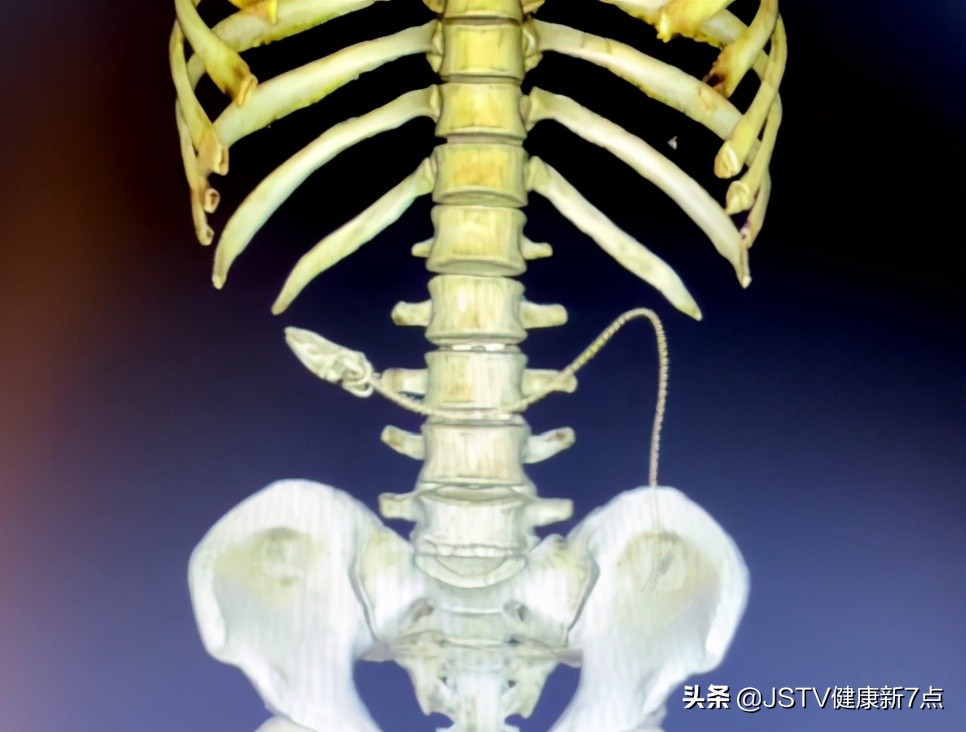 突发！长约40公分黄鳝从男子肛门钻进肚子