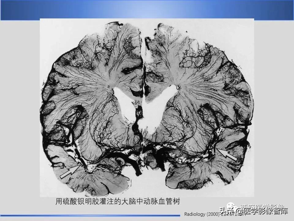 vr间隙概念,vr间隙需要做什么检查