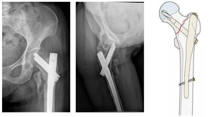 老人髋部骨折多长时间恢复到正常,老年人骨折无法固定怎么办