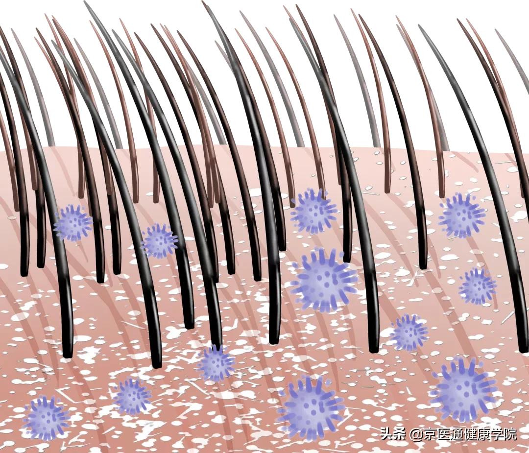 皮肤科去头屑,张文鹤医生碘伏去头屑