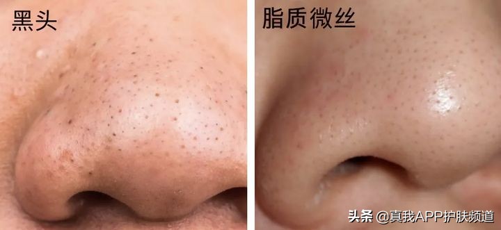 顽固黑头怎么去除最有效,变美小知识黑头怎么去掉