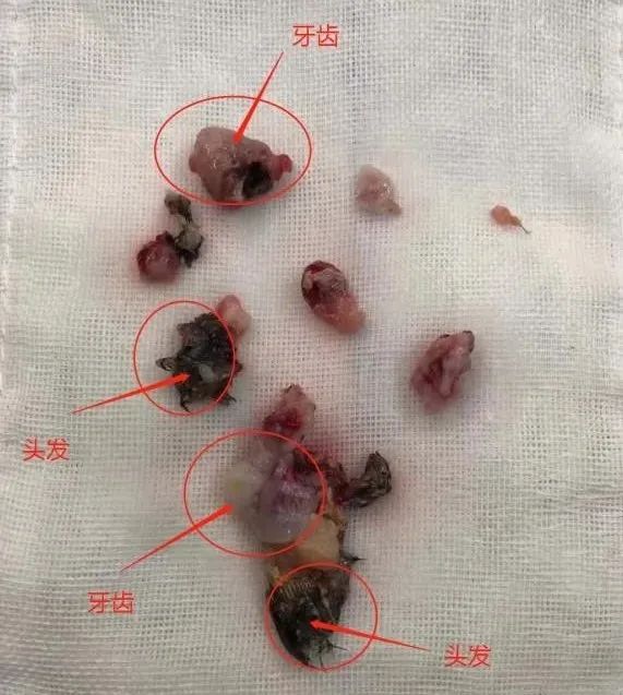五岁男孩牙齿一长一短,5岁男孩的牙齿居然长在了脑袋里