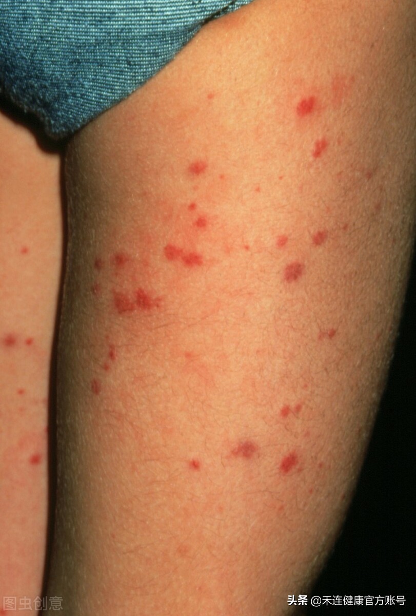 身上长小红点是肝不好吗,肝出什么问题身上会有小红点