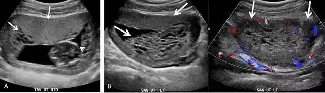 临床上最常见的异常胎盘,前置胎盘和低置胎盘超声