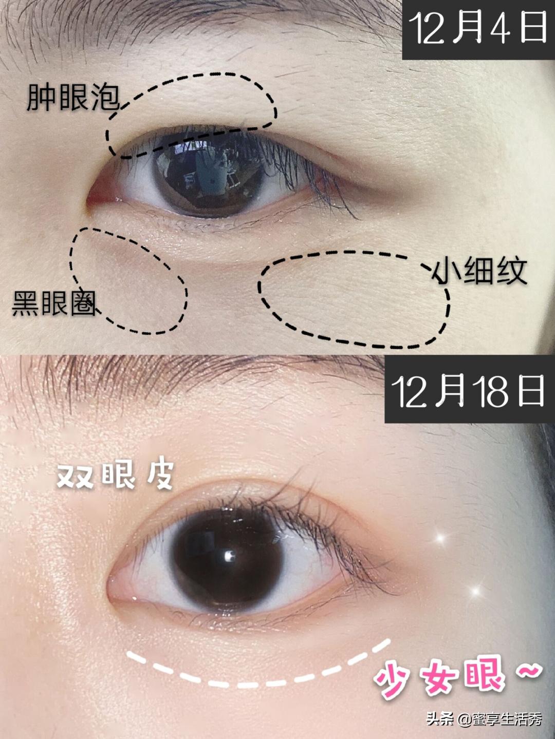 内双眼皮怎么变外双按摩最有效,内双眼皮手术变外双效果