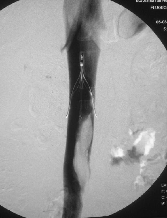 已经出现经济舱综合征怎么办,如何预防经济舱综合症