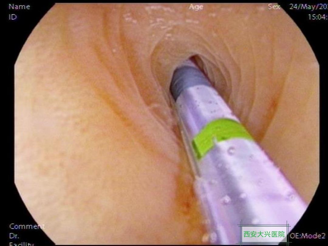 不开刀可以治愈阑尾炎吗,新方法不开刀也能治疗阑尾炎