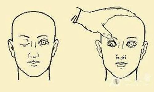 动脉瘤破裂时有什么症状,颅内动脉瘤有什么症状和表现