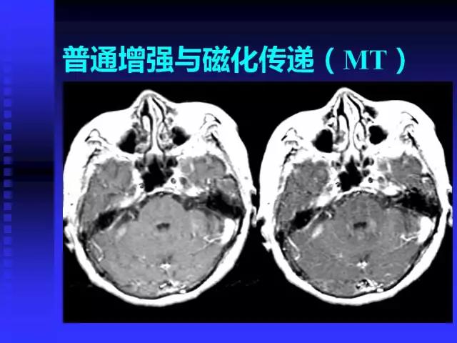 头颅mri读片视频教程,颅脑mri读片入门教程视频讲解全集