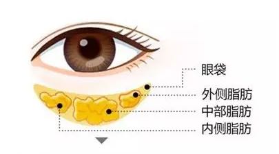 祛眼袋没有卧蚕了,没有卧蚕明星
