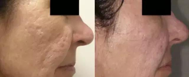 美容微针毁容视频,微针美容副作用怎么修复