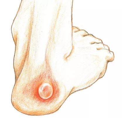 如何预防与处理比跑步膝痛还烦人的水泡？