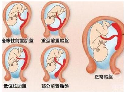 为什么前置胎盘孕晚期容易出血,孕妇晚期前置胎盘出血是什么原因