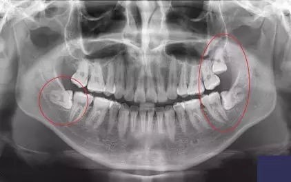 智齿到底应不应该拔,智齿到底要不要拔除
