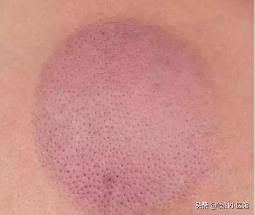 中医火罐疗法有哪些注意事项,中医火罐穴位图