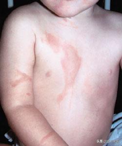 烧烫伤紧急处理谣言,烧烫伤祖传秘方怎样推广