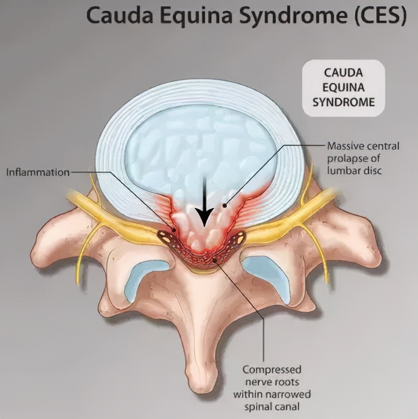 腰椎间盘突出压迫哪个神经,压迫坐骨神经和马尾神经