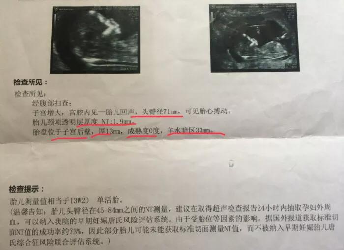 胎儿如何检查智力发育,b超单怎么看出胎儿boy还是girl