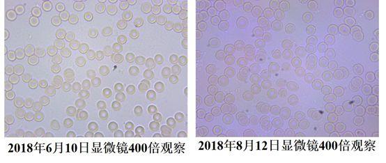血液粘稠的病因及治疗,健康血液粘稠别小看但也别乱治
