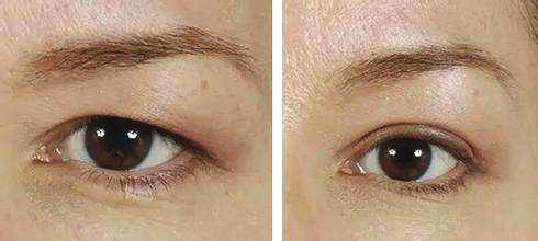 提眉做成倒三角眼能恢复正常吗,三角眼适合做提眉吗