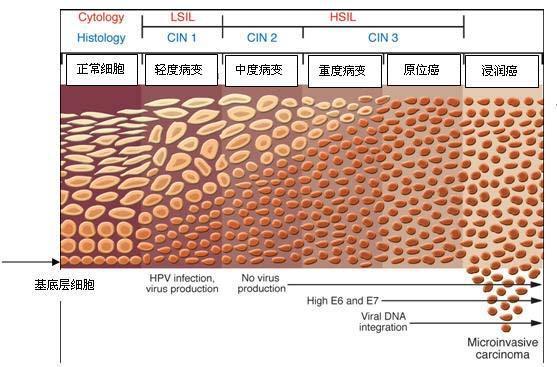 宫颈病变二级离癌多远,宫颈活检il级病变是癌吗