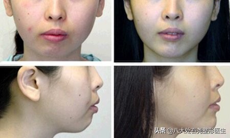 广东中医院自体脂肪填充后缩下巴,下巴自体脂肪填充需要多久