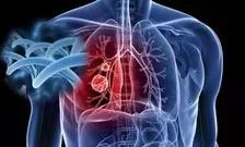 肺癌患者福音：肺癌已被“攻克”，联合疗法成为治疗肺癌潜力股