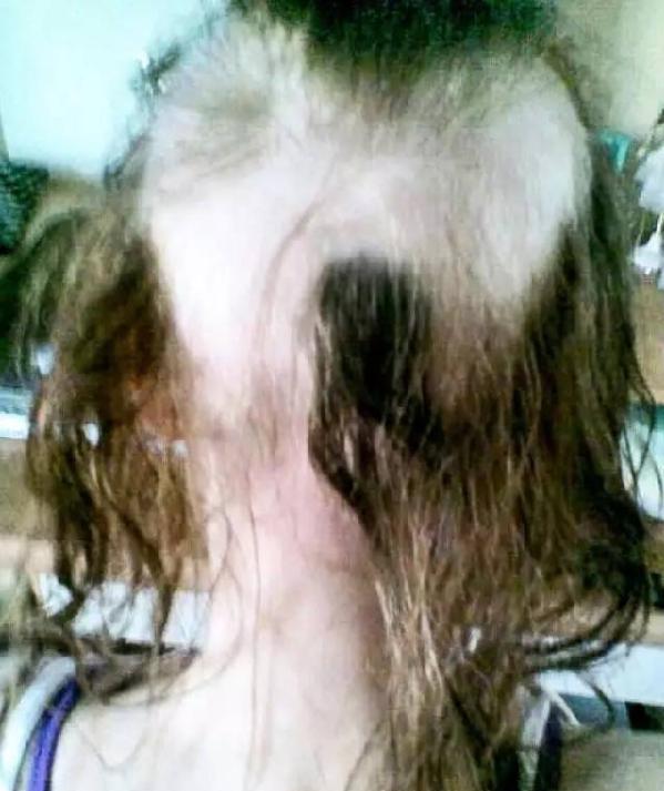 选美皇后是秃子？当众摘下假发引热议！没想到这两个冠军也是秃头