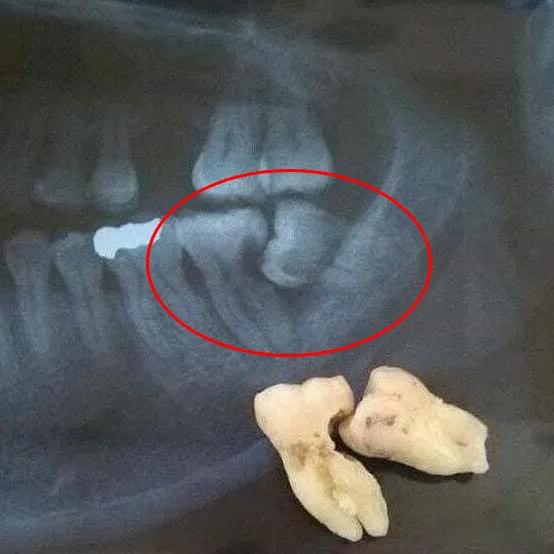 有没有智齿不拔的案例,我有个智齿没长出来怎么拔