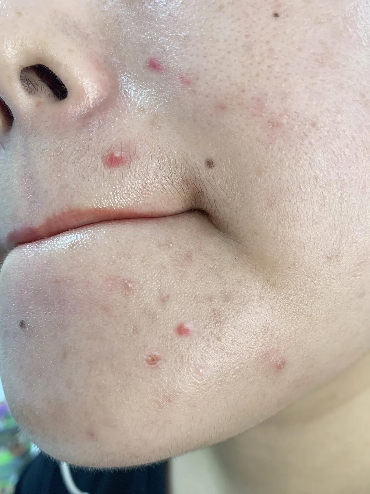 油痘肌不长痘痘了是不是快好了,油痘肌的痘痘