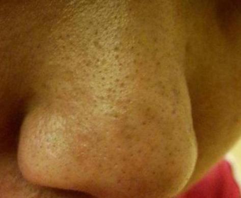 打败毛孔！下一个反孔精英就是你！