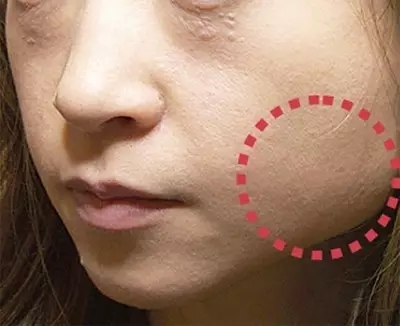 瘦脸针科普,科普打瘦脸针脸会凹陷变松吗