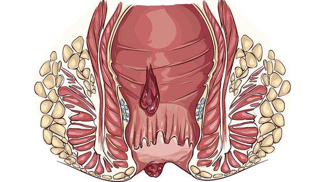 天气潮湿引起肛周脓肿,天气炎热肛周不适的原因