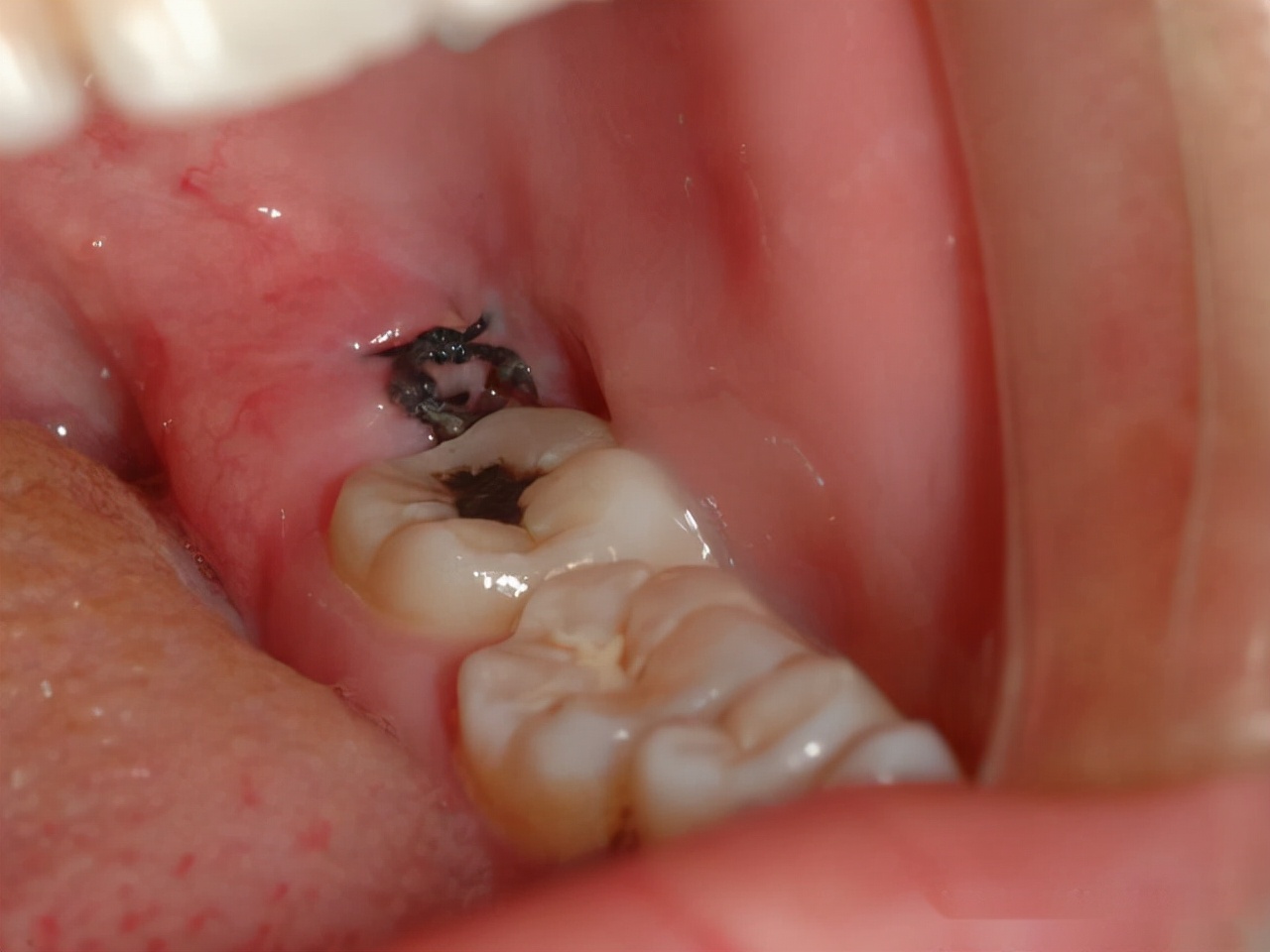 拔牙干槽症几天能治愈,干槽症不处理牙窝会愈合吗