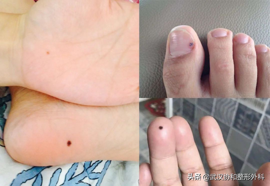 两毫米的痣医生要切,切痣医生怎么判断有没有切干净