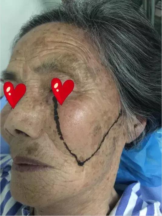 痛得拔光一排牙！解决炸裂“天下第一痛”一根套管针显乾坤