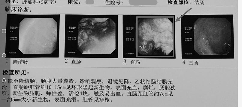 痔疮便血与大肠癌的区别,大肠癌的四个症状常被以为是痔疮