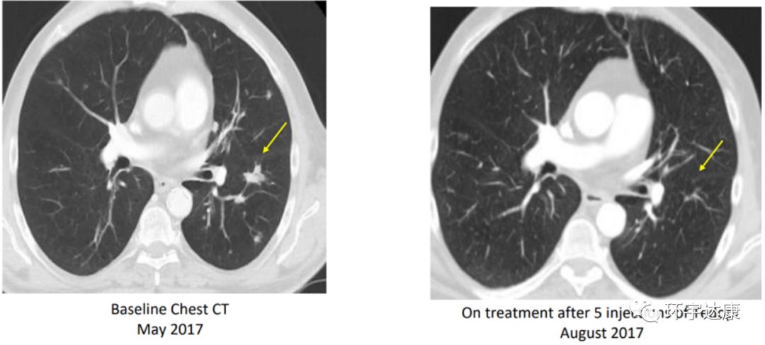 世界上完全可以预防的癌症疫苗,未来10年癌症有可能被攻克吗
