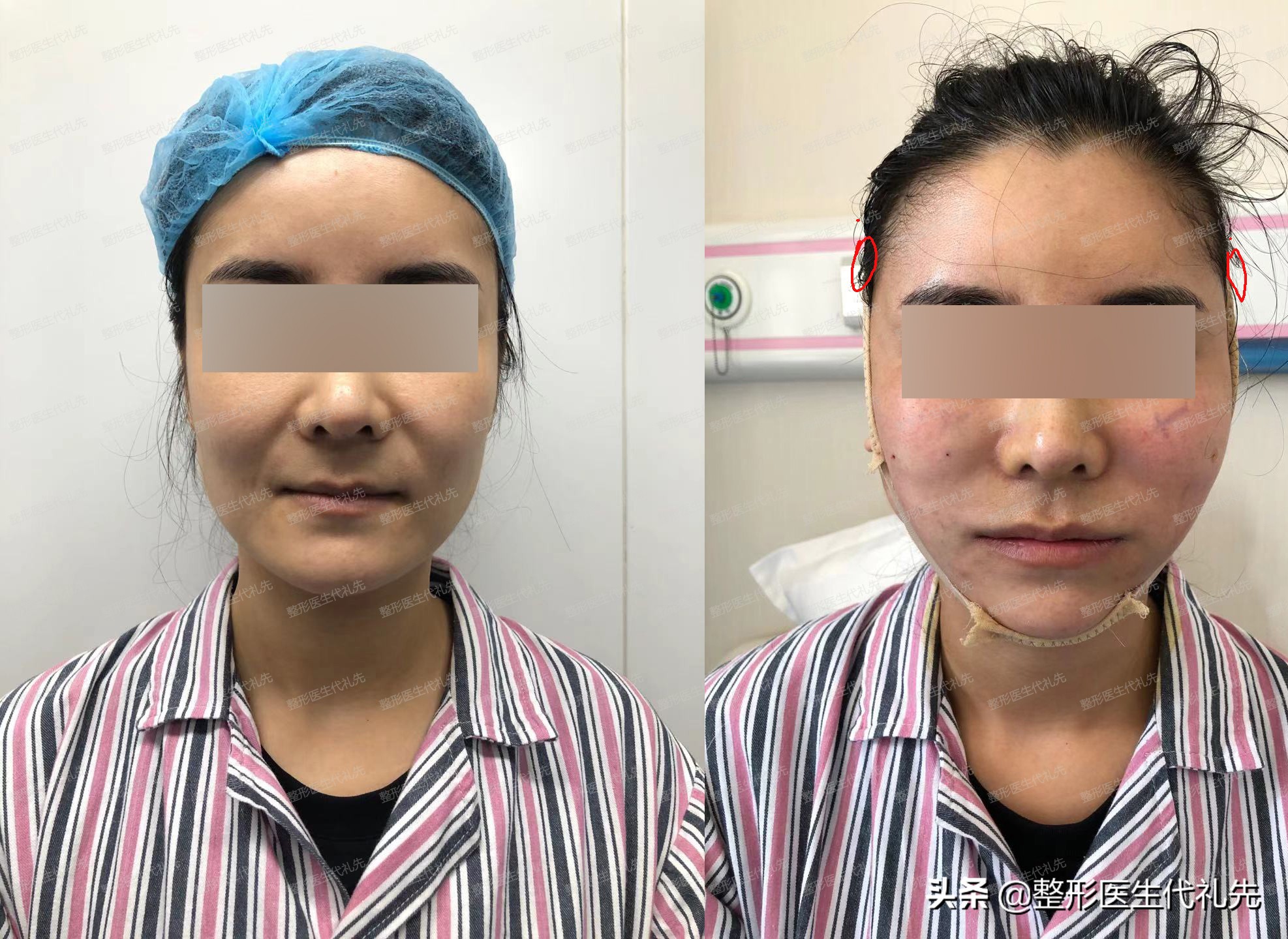 剥离拉皮提拉紧致,拉皮提拉紧致抗皱手术